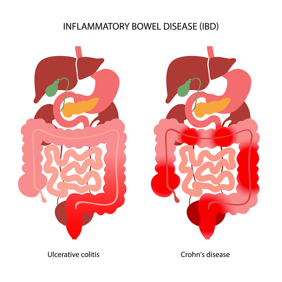 inflammatory bowel disease 
differences between ulcerative colitis and crohn's disease 
